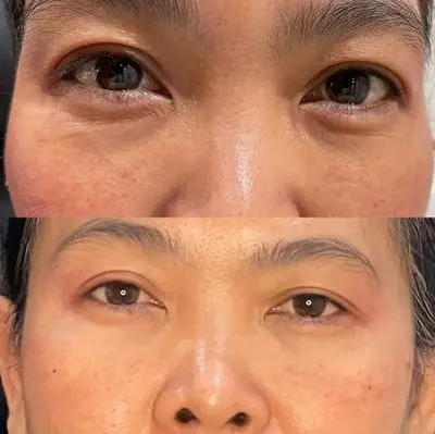 Lib & Tear Fillers